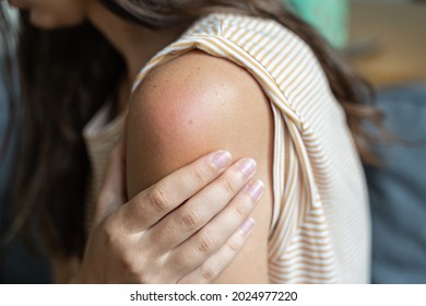 Side effect of the vaccine - shoulder skin redness and pain. Covid-19 vaccination reaction. Woman skin itchy and swelling after vaccine shot