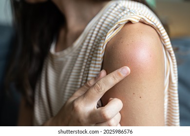 Side Effect Of The Vaccine - Shoulder Skin Redness And Pain. Covid-19 Vaccination Reaction. Woman Skin Itchy And Swelling After Vaccine Shot