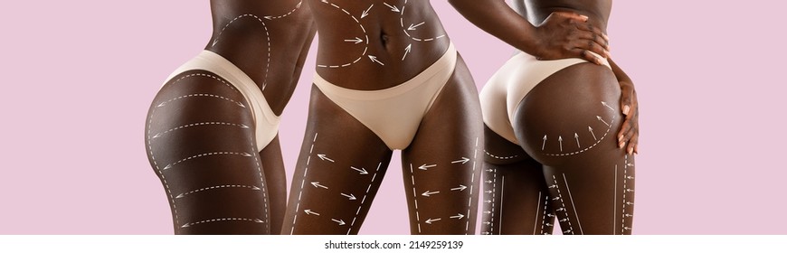 Side, front and back view of unrecognizable black lady in nude panties with white pen marks on her hips, buttocks and belly, getting ready for body sculpting surgery, purple background, collage