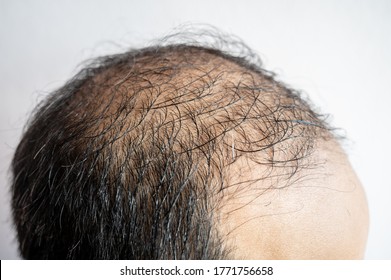 1,918 Scalp conditions Images, Stock Photos & Vectors | Shutterstock