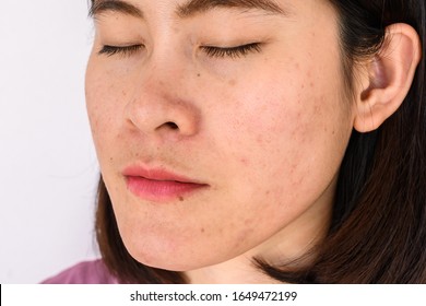 Side View Close-up Of Woman Face Has Variety Problems On Her Skin (such As Acne, Pimple, Pores And Melasma Etc). Conceptual Of Natural Problem On Woman Skin.