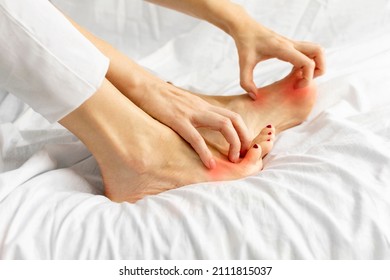 Side View Of Female Hands Scratch Legs Sitting On White Bed At Home. Itchy Skin, Fungus, Fungal Bacterial Infection, Allergic Reaction, Eczema, Dermatitis Of The Foot. Health And Skincare Concept.