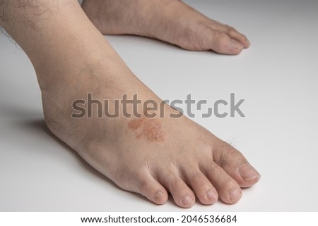 Side view of foot infected with ringworm, athlete's foot or tinea pedis fungal infection. on white background.