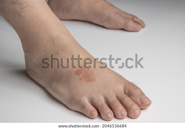 Side view of foot\
infected with ringworm, athlete\'s foot or tinea pedis fungal\
infection. on white\
background.