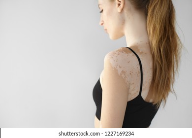 Side View Of Gorgeous Slender Young European Woman With Long Ponytail Looking Down, Showing White Vitiligo Spots On Her Back And Arm. People, Dermatology, Beauty, Depigmentation And Skin Disorder