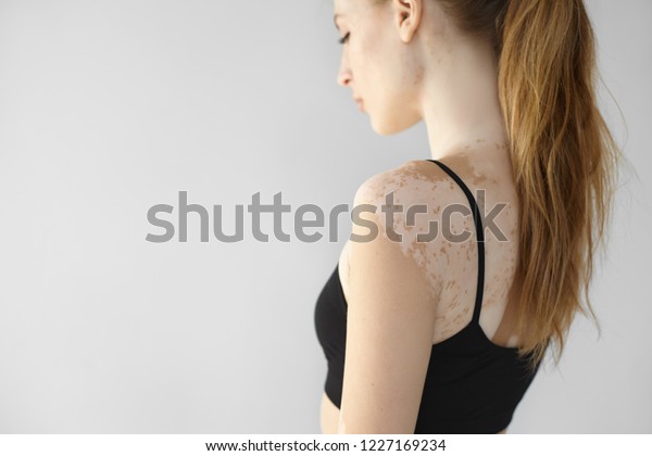 長いポニーテールを下に向け 白い白い白い斑点を背中と腕に見せる 華やかなほっそりした若いヨーロッパ人女性の側面 ヒト 皮膚科 美容 脱色 皮膚障害 の写真素材 今すぐ編集