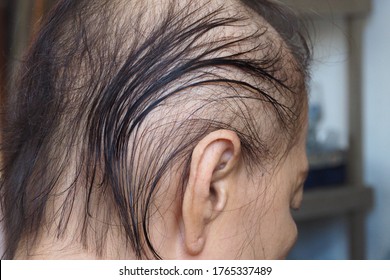 Side View Of An Old Asian Woman Having Hair Fall Problems During Her Chemotherapy Course