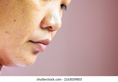 Side View Photo Of 40 Years Old Asian Woman With Acne, Wrinkle, Fleck, And Blemish On Her Face. Health And Skin Problem Concept.