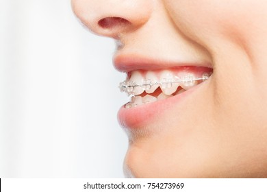 Side View Picture Of Woman Smile With Clear Braces