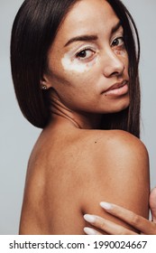 Side View Portrait Of A Woman Having Vitiligo. Close Up Of A Confident Young Woman With Unique Skin.