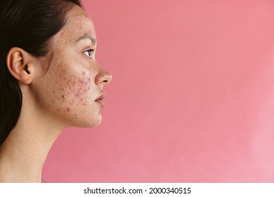 Side view portrait of a woman having acne inflammation. Close up of a depressed young woman with skin problem on pink background.