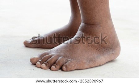 Side view of swollen feet on both sides. health problems of the elderly. Diabetes in the elderly and overweight. stand barefoot on the concrete floor. 