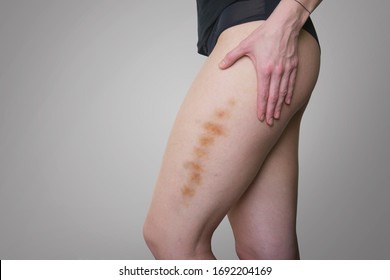 Side View Of A Young Woman In Black Underwear Holding Her Arm On Her Leg With A Big Purple Skin Bruise.