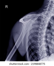 Side Xray Shoulder See Fracture Shoulder Stock Photo 2198848775 ...