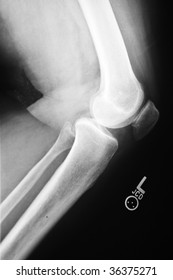 Side Xray View Injured Knee Stock Photo 36375271 | Shutterstock