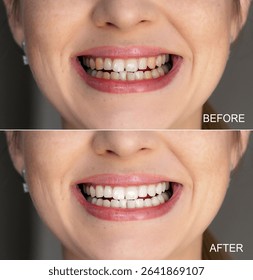Side-by-side comparison image displaying teeth whitening improvement before and after treatment.