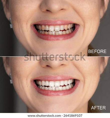 Side-by-side comparison image displaying teeth whitening improvement before and after treatment.