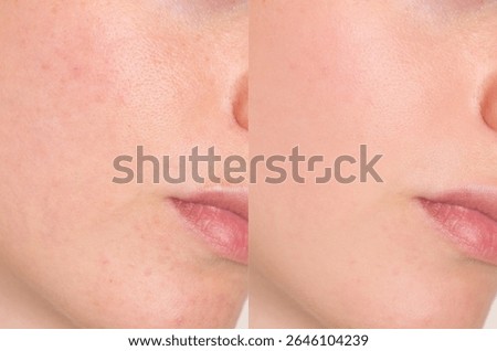 Side-by-side macro image shows visible reduction of pores, redness and blemishes on a woman’s cheek and nose. Great for skincare results, dermatology, cosmetic ads and educational use.
