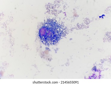 Siderophage  Cells  In Cerebrospinal Fluid.100X