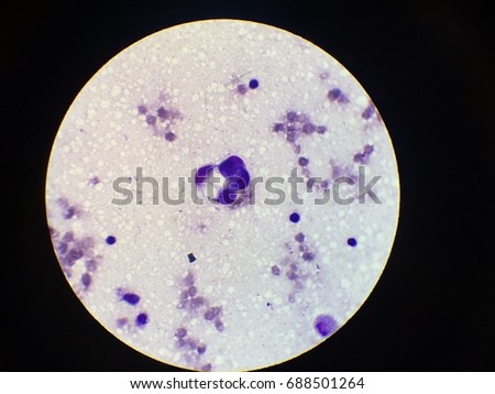 Signet ring cell