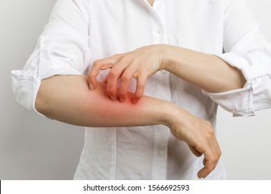 Signs Of Dermatitis And Scabies. Woman Scratches Her Hands. Skin Allergy.