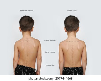 Signs Of Scoliosis. Normal healthy spine and curved spine with scoliosis.Scoliosis in children