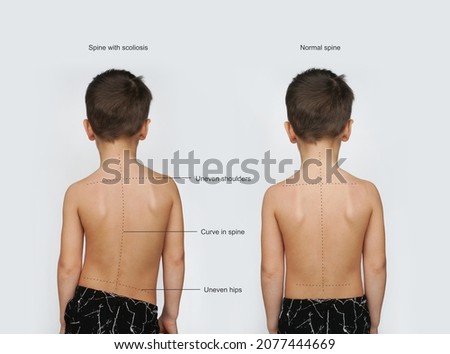 Signs Of Scoliosis. Normal healthy spine and curved spine with scoliosis.Scoliosis in children