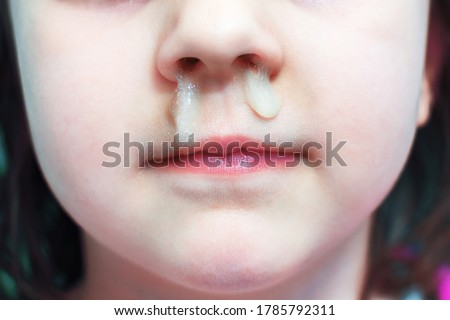 Signs of the virus.Snot flows from the nose of a little girl.Mucus from a part of the body.Prevention of viral infections