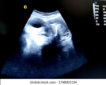 Simple Cyst  T- Shaped Intrauterine Device By Ultrasound Cyst With IUD 