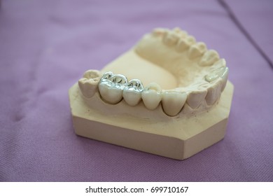 Simple of denture for fill teeth, tooth amalgam filling.
