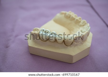 Simple of denture for fill teeth, tooth amalgam filling.