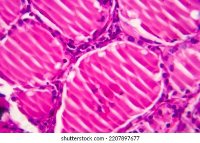 Simple Goiter Light Micrograph Photo Under Stock Photo 2207897677 ...