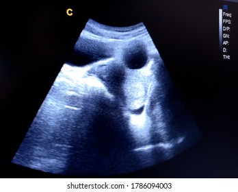 Simple Ovary Cyst Retroverted Uterus By Ultrasound Scan