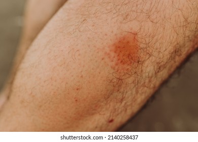 Simuliidae black fly bite mark on the leg below the knee, selective focus