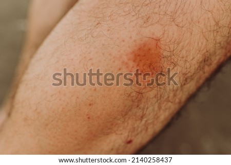 Simuliidae black fly bite mark on the leg below the knee, selective focus