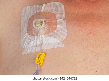 Single Lumen Implanted Chest Port: port implanted beneath skin to facilitate cancer chemotherapy treatments, with IV line & clamps & filters