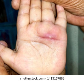 cellulitis hand child