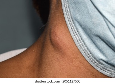 Single Swelling Or Lymph Node At The Neck Of Asian Woman.