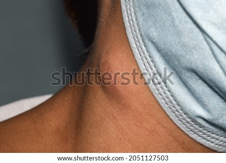 Single swelling or lymph node at the neck of Asian woman.