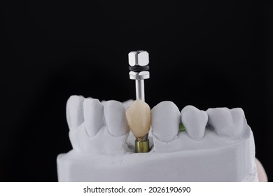 Single Teeth Implant Restoration On Dental Model With Black Background.