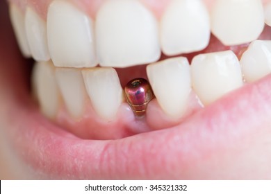 Single Tooth Implant