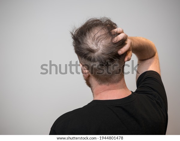 A single young caucasian male checking his bald patch on\
the back of his head, which shows clear signs of balding and hair\
loss. Shot against a white background with isolated man and room\
for text. 