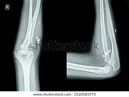 Sinogram X ray of elbow joint showing Foreign body in situ also known as Gossypiboma