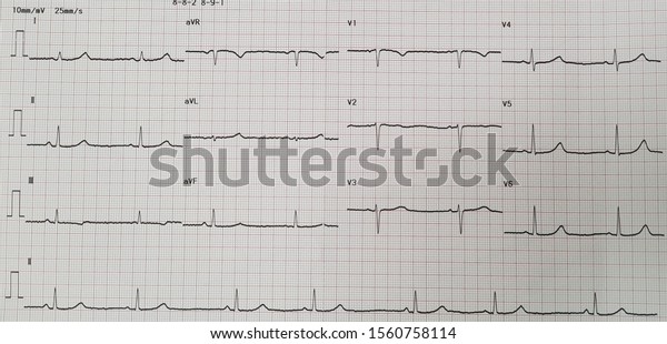 Sinus Bradycardia Rate 40 Bpm Bradyarrhyrhmia Stock Photo 1560758114 ...