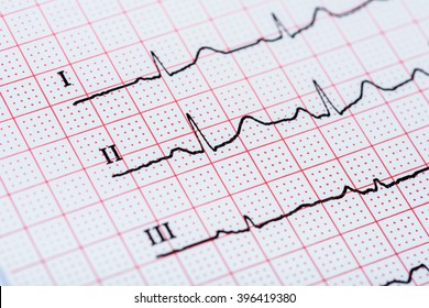 Sinus Heart Rhythm On Electrocardiogram Record Paper Showing Normal P Wave, PR And QT Interval And QRS Complex