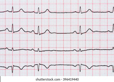 Sinus Heart Rhythm On Electrocardiogram Record Paper Showing Normal P Wave, PR And QT Interval And QRS Complex