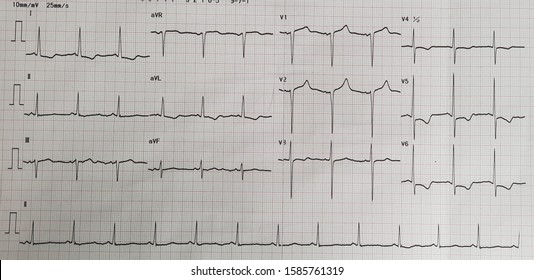 Sinus Rhythm With Left Ventricular Hypertrophy. LVH.