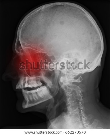 Sinus skull x-ray
