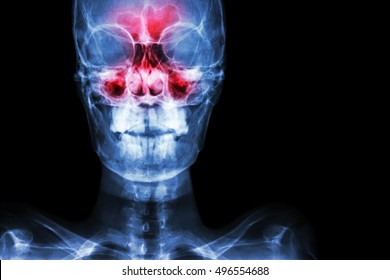 Sinusitis. Film X-ray Skull AP ( Anterior - Posterior ) Show Infection And Inflammation At Frontal Sinus , Ethmoid Sinus , Maxillary Sinus And Blank Area At Right Side