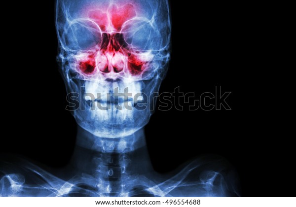 Sinusitis. film x-ray skull AP (\
anterior - posterior ) show infection and inflammation at frontal\
sinus , ethmoid sinus , maxillary sinus and blank area at right\
side